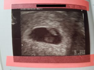 Ultraschall noch ein Baby